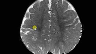 Perinatal hypoxic injuty with white matter paucity and gliosis Ulegyria [upl. by Yecad663]