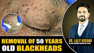 REMOVAL OF 50 YEARS OLD BLACKHEADS II Dr Lalit Kasanas [upl. by Viehmann]