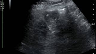 Subcapsular Hematoma Ultrasound JETem 2018 [upl. by Naelopan]