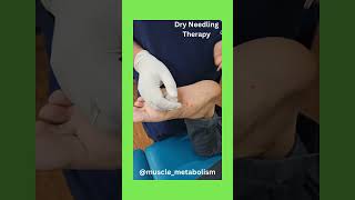 Dry needling therapy [upl. by Nnyluqcaj]