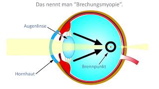 Kurzsichtigkeit Myopie Defintion Ursachen und Wirkung [upl. by Garaway539]