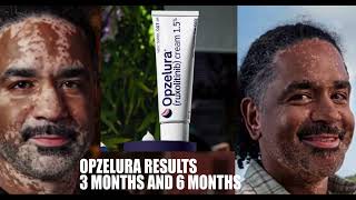 Vitiligo Treatment Results With Opzelura 36 Months [upl. by Atinnek]