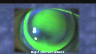 Keratoconus and Cross Linking [upl. by Yelraf]