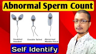 Abnormal Sperm Morphology  Abnormal Sperm Count  Abnormal Sperm Analysis [upl. by Nine]