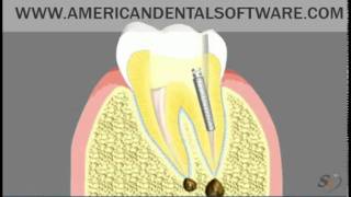 Dental Patient Education Root Canal Treatment Animated Movieflv [upl. by Johm]