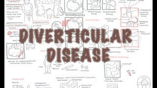 Diverticular Disease diverticulitis  Overview [upl. by Metsky]