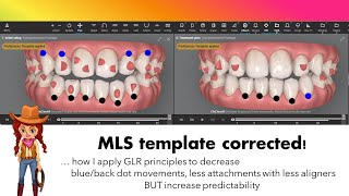 Invisalign ClinCheck  MLS vs GLR templates [upl. by Busby647]