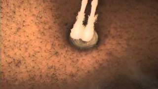 NonSurgical Keloid Treatment with Cryotherapy [upl. by Schatz]