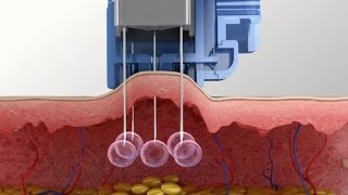 Meso Injector system for Mesotherapy Injection [upl. by Griffy135]