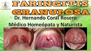 FARINGITIS GRANULOSA  INFLAMACIÓN DE LA FARINGE CON PERI ADENITIS COLORACIÓN ROJIZA [upl. by Biebel]