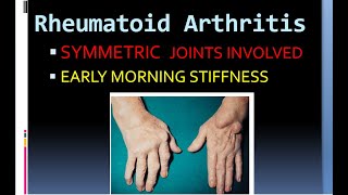 Pathology 860 Rheumatoid Arthritis Hladr4 hladr1 ankylosis pannus rheumatoid factor [upl. by Scevo534]