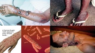 BBC Documentary 2017  EBOLA The Truth About Deadly Virus  National Geogrpahic Science 2017 [upl. by Rotsen]