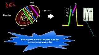 CURSO DE ELECTROCARDIOGRAFIA 44  BLOQUEO DE RAMA IZQUIERDA [upl. by Nosnorb]