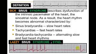 EKG SICK SINUS SYNDROME [upl. by Vivienne]