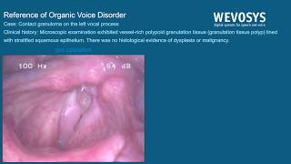 Contact granuloma on the left vocal process [upl. by Steele639]