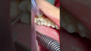 Remoção de cárie dentáriacárie dentes dentist odontologia [upl. by Devad]