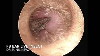 Foreign Body Ear live insect  Endoscopic Removal [upl. by Childs]