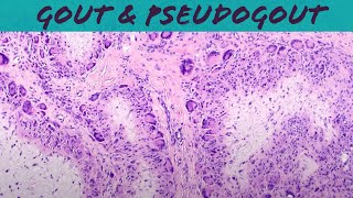 Gout amp Pseudogout calcium pyrophosphate deposition disease  chondrocalcinosis pathology USMLE [upl. by Flessel]