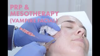 Vampire Facial AKA PRP amp Mesotherapy How it Works  Results [upl. by Sanfred48]