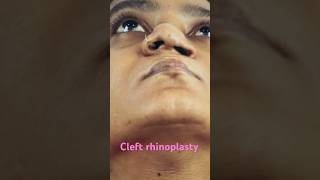 cleft rhinoplasty  World Class  Richardsons [upl. by Hugh]