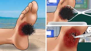 ASMR Animation Remove sea urchins from feet  Satisfying [upl. by Pascoe]