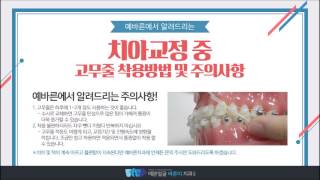 치아교정 고무줄 사용시 주의사항건대치아교정치과예쁜얼굴바른이치과 [upl. by Layman]