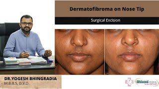 Dermatofibroma on nose  Surgical excision  Dr Yogesh Bhingradia [upl. by Lokkin]