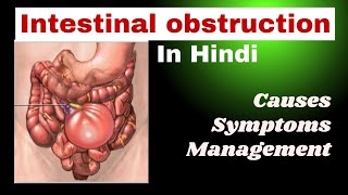 Intestinal obstruction in hindi  Bowel obstruction  cause symptoms management  nursing lecture [upl. by Ekram546]