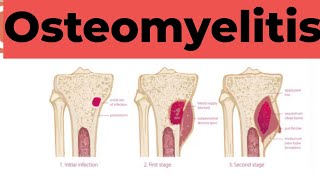 Osteomyelitis  Causes Sign and Symptoms Diagnosis amp Treatment Pathology [upl. by Assirim]