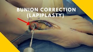 Full Bunion Correction  Lapiplasty Procedure Demonstration [upl. by Eesdnyl]