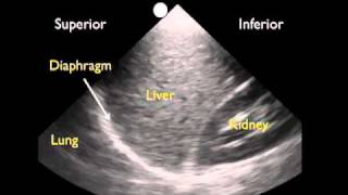 How To Ultrasound Detection of Pleural Fluid Case Study Video [upl. by Aloke]