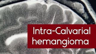 IntraCalvarial hemangioma on MRI scan  osseous venous lowflow vascular malformations mri [upl. by Bannerman]