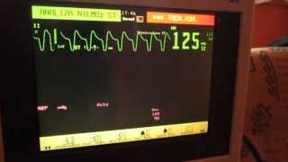 EKG Monitor [upl. by Wehttam]