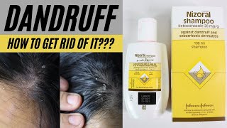 Dandruff  Flaky Itchy Scalp  Nizoral Shampoo Review [upl. by Oam53]