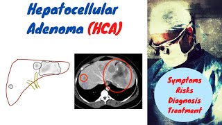 Hepatocellular Adenoma  Liver Cell Adenoma  HCA [upl. by Luhem]