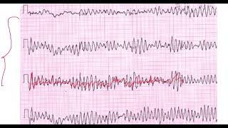 Fibrilación Ventricular vs Torsades de pointes EKG [upl. by Mateo]