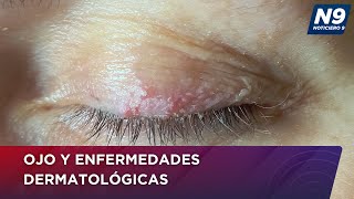 OJO Y ENFERMEDADES DERMATOLÓGICAS  NOTICIERO 9 [upl. by Shabbir485]