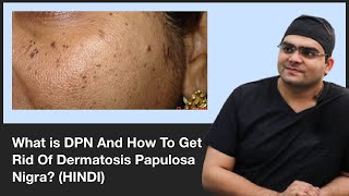 What is DPN And How To Get Rid Of Dermatosis Papulosa Nigra  ClearSkin Pune  In HINDI [upl. by Buckels106]