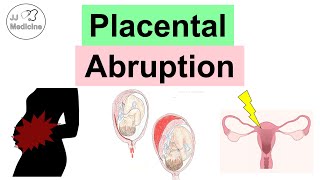 Placental Abruption Abruptio Placentae Risk Factors Symptoms Complications Diagnosis Treatment [upl. by Hennessy]