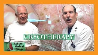 Actinic Keratosis Frozen with Cryotherapy  Auburn Medical Group [upl. by Eatnoed23]