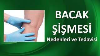 BACAK ŞİŞMESİ NEDENLERİ VE TEDAVİSİ [upl. by Sheba596]