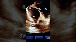 Superior vena cava subcostal view echocardiography Dr Tarvinderjit Khurana MD Patiala [upl. by Kamal]