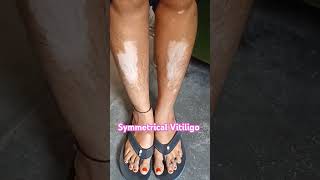 Vitiligo healthtipsinhindi dermatology skindiseases skin charmrog [upl. by Eba]