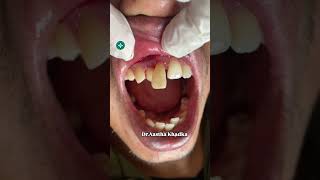 Discolored tooth Dr Aastha Khadka Dentistdiscoloration teeth swasthyapharmacy dentist short [upl. by Lazes]