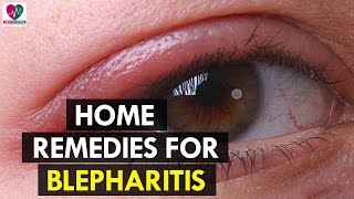 Home Remedies for Blepharitis  Health Sutra [upl. by Annuahsal]