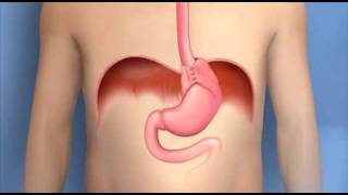 Antireflux Surgery FundoplicationMayo Clinic [upl. by Lizned]