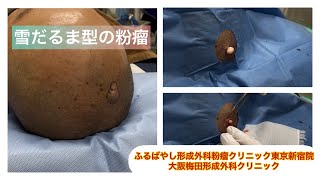 東京皮膚のできものと粉瘤クリニック ふるばやし形成外科新宿院 大阪梅田形成外科クリニック ブログでも詳しく解説してます。 頭部の雪だるま型の粉瘤 くりぬき法 2箇所に分かれていた症例 Dr Gen [upl. by Ahsele]