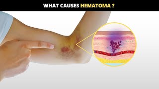 Unveiling Hematomas  Causes Symptoms amp Solutions [upl. by Nytsua]