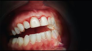 How To Get Rid Of Bleeding Gums at Home [upl. by Milt]