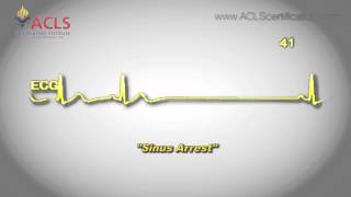 Sinus Arrest by ACLS Certification Institute [upl. by Anilef381]